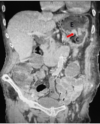 fistula gastrocólica