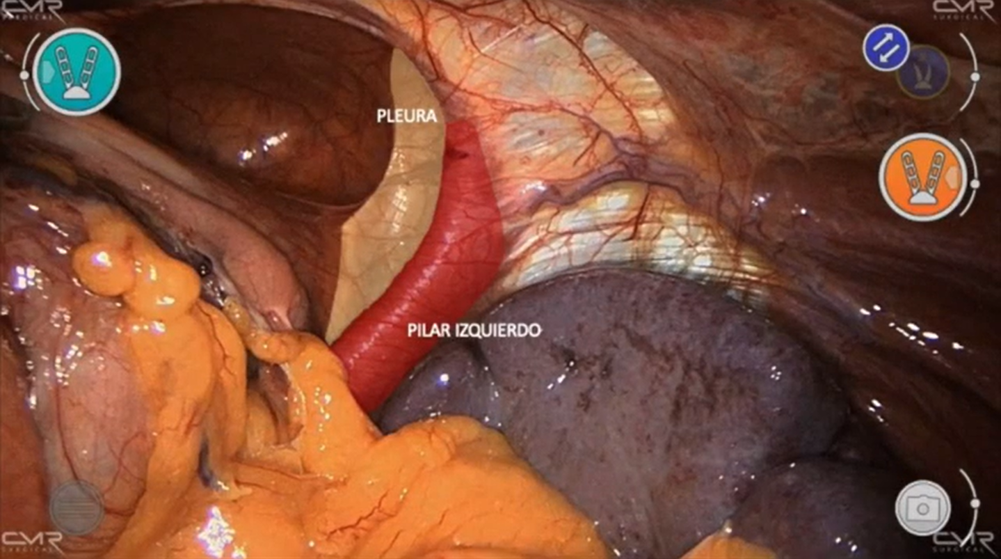 hernia