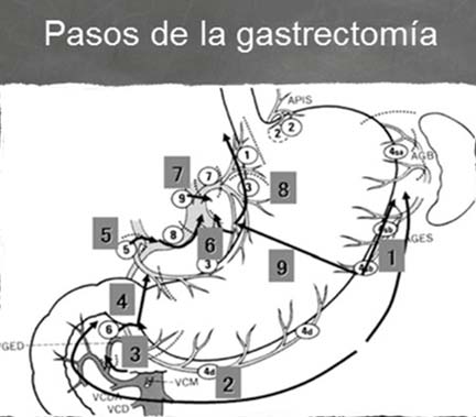 gastrectomia