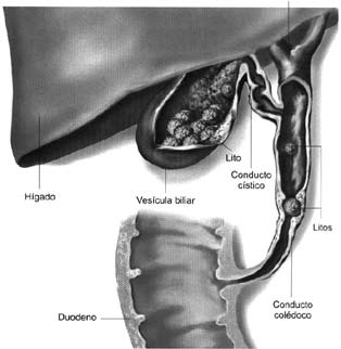 litiasis biliar