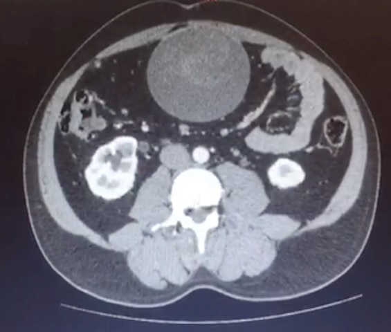 seudotumor.jpg